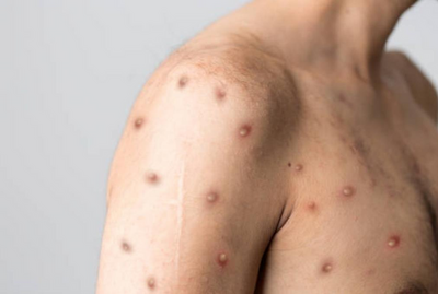 Governo de Rondônia confirma oito casos de Mpox e alerta população sobre prevenção